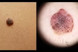 Dermoscopy Mole Evaluation Clinic Dubai