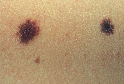 Dermoscopy Mole Evaluation Dubai & Abu Dhabi