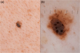 Dermoscopy Mole Evaluation Dubai