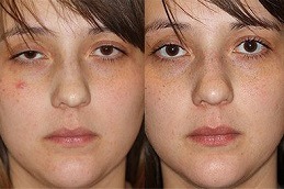 Eyelid Surgery for Droopy Eyelids in Dubai