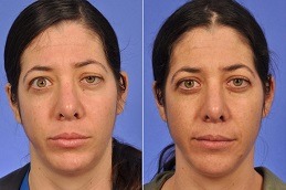 Eyelid Surgery for Thyroid Eye Disease Dubai