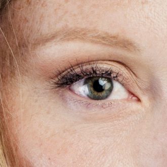 Eyelid Surgery for Thyroid Eye Disease Dubai