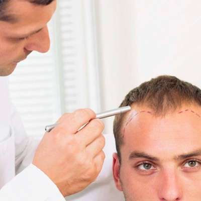 Hair Transplant for Male Pattern Baldness Cost in Dubai & Abu Dhabi