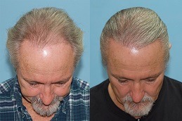 Hair Transplant for White Hair Dubai