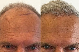 Hair Transplant for White Hair in Dubai