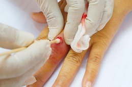Incision and Drainage of Abscesses