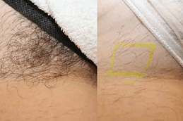 Laser Hair Removal for Pubic Area Dubai