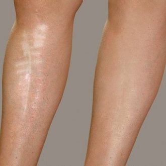 Laser Treatment for Scars on Legs Dubai UAE