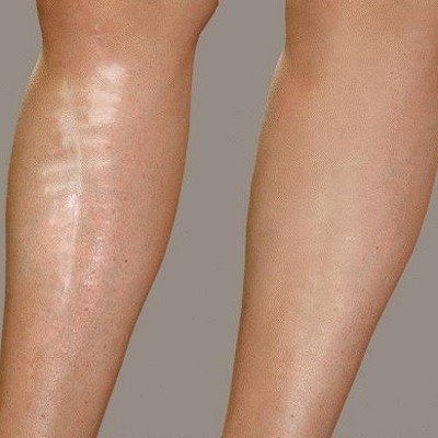 Laser Treatment For Scars on Legs in Dubai, Abu Dhabi & Sharjah UAE