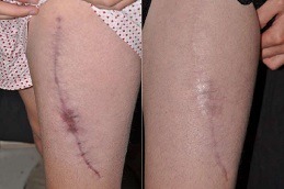Laser Treatment for Scars on Legs in Dubai UAE