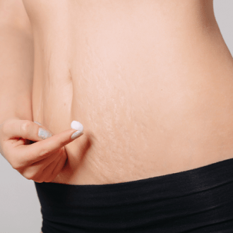 Laser Treatment for Stretch Marks Dark Skin