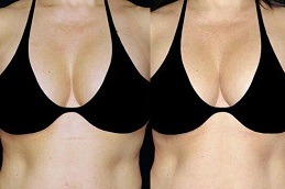 Liposuction Surgery for Breast in Dubai UAE