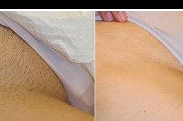 Permanent Hair Removal for Private Areas Dubai