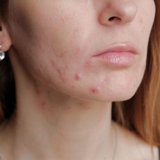 Pimples Treatment Cost in Dubai