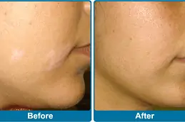 Skin Whitening Treatment for Vitiligo Patients Dubai