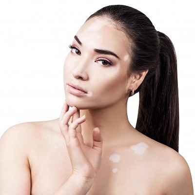 Skin Whitening Treatment for Vitiligo Patients in Dubai & Abu Dhabi