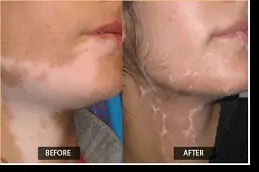 Skin Whitening Treatment for Vitiligo Patients in Dubai