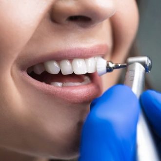 Teeth Cleaning Cost in Dubai UAE & Abu Dhabi