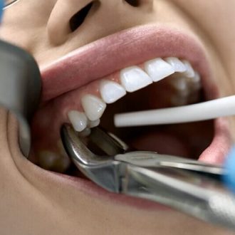 Tooth Extraction Cost in Dubai & Abu Dhabi