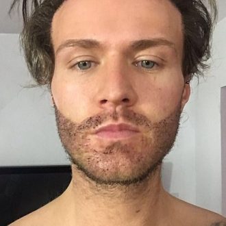 Ways to Fix Your Patchy Beard in Dubai UAE