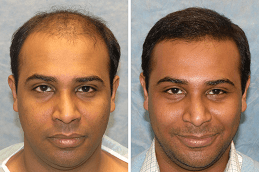 Best Clinic of FUE Hair Transplant Cost Dubai & Abu Dhabi