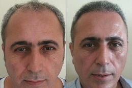 Best Clinic of FUE Hair Transplant Cost in Dubai & Abu Dhabi
