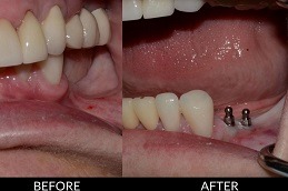 Best Clinic of Full Mouth Dental Implants Cost in Dubai UAE