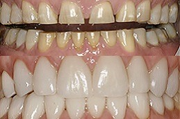 Best Clinic of Gum Depigmentation Abu Dhabi 
