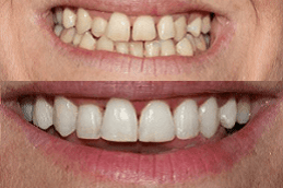 Best Clinic of Overlapping Teeth Treatment in Abu Dhabi