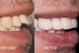 Best Clinic of Protruding Teeth Treatment Cost in Dubai