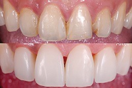 Best Clinic of SMART Dental Amalgam Removal in Dubai