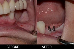 Best Clinic of Single Tooth Implant Cost Dubai & Abu Dhabi