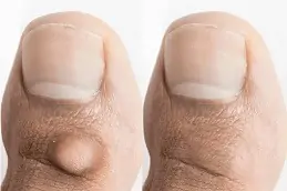 Best Clinic of Skin Wart Removal Cost Dubai & Abu Dhabi