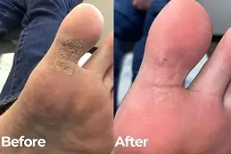 Best Clinic of Skin Wart Removal Cost in Dubai & Abu Dhabi