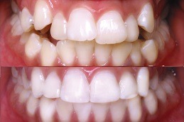 Best Clinic of Teeth Straightening in Abu Dhabi