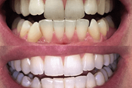 Best Clinic of Teeth Straightening in Dubai