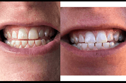 Best Clinic of Teeth Whitening Strips Cost Dubai & Abu Dhabi