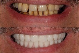 Best Clinic of Tooth Removal in Dubai