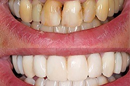 Best Dental Tooth Calculus in Dubai