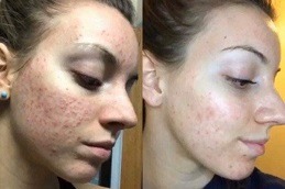 Best Dermatologist Dubai for Acne Scars