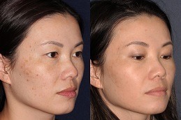 Best Fractional Laser for Acne Scars Cost in Dubai
