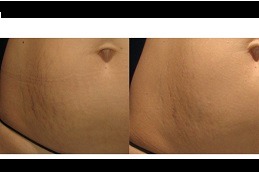 Best How to Get Rid of Stretch Marks on Stomach Dubai