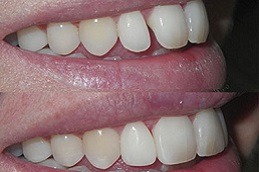 Best Overlapping Teeth Treatment in Dubai