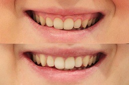 Best Pink Gums With Laser in Abu Dhabi