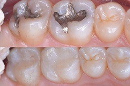 Best SMART Dental Amalgam Removal in Dubai