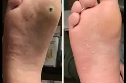 Best Skin Wart Removal Cost Dubai & Abu Dhabi