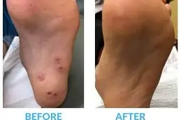 Best Skin Wart Removal Cost in Dubai & Abu Dhabi