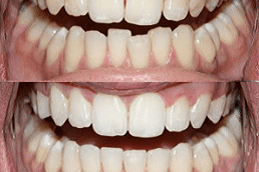 Best Teeth Straightening in Dubai