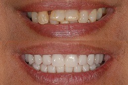 Best Tooth Removal in Abu Dhabi