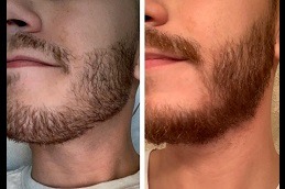 Best Ways to Fix Your Patchy Beard Dubai UAE